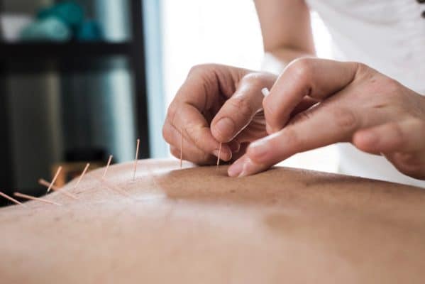 Dry needling on the back